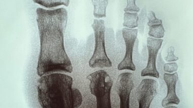 Xray of a foot