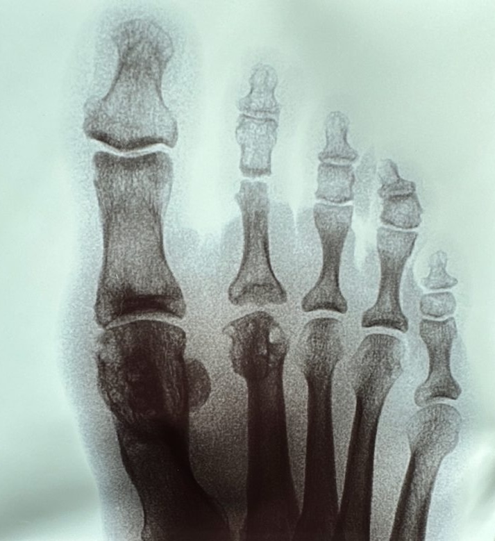 Bunion & Hammertoe Surgery: What No One Tells You About Recovery